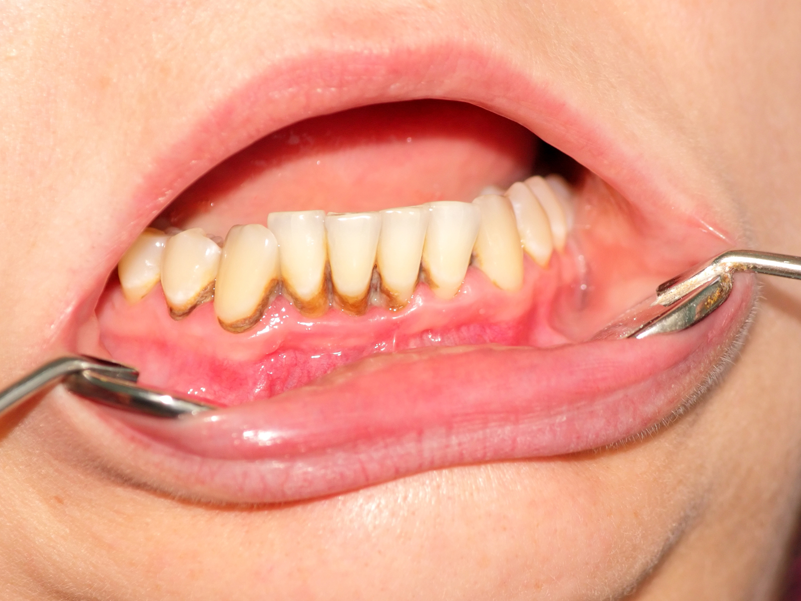 Can you scrape tartar off your teeth?