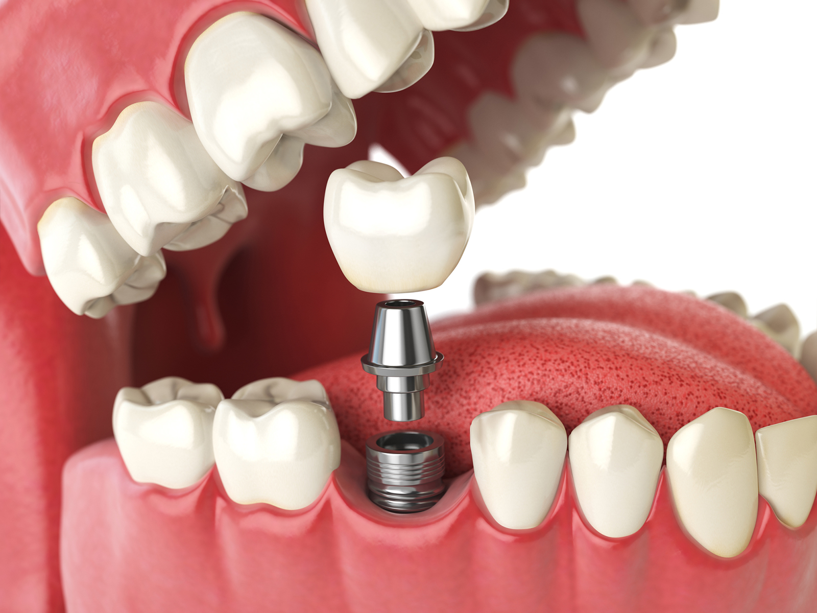 Can front teeth be implanted?
