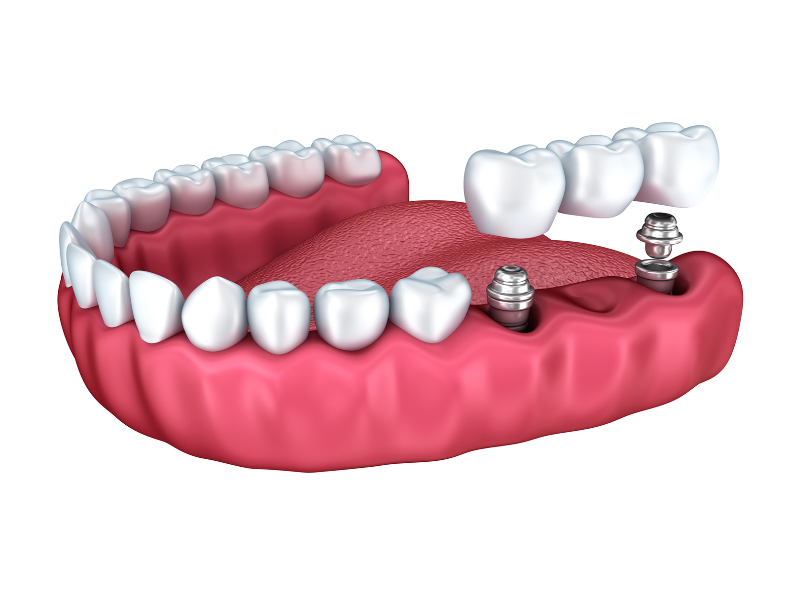 Does food get under dental implants?