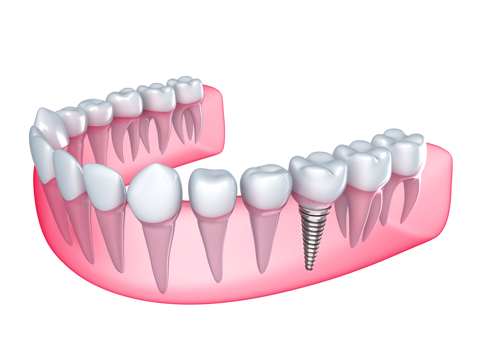How much do dental implants cost?