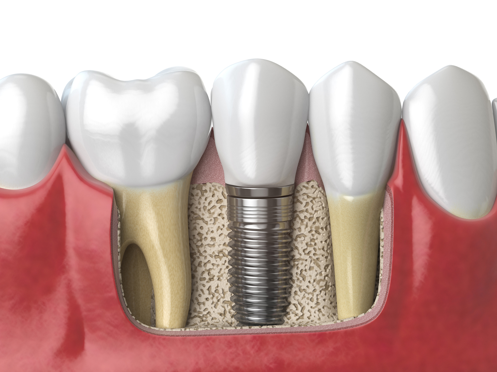 Why are tooth implants so expensive?
