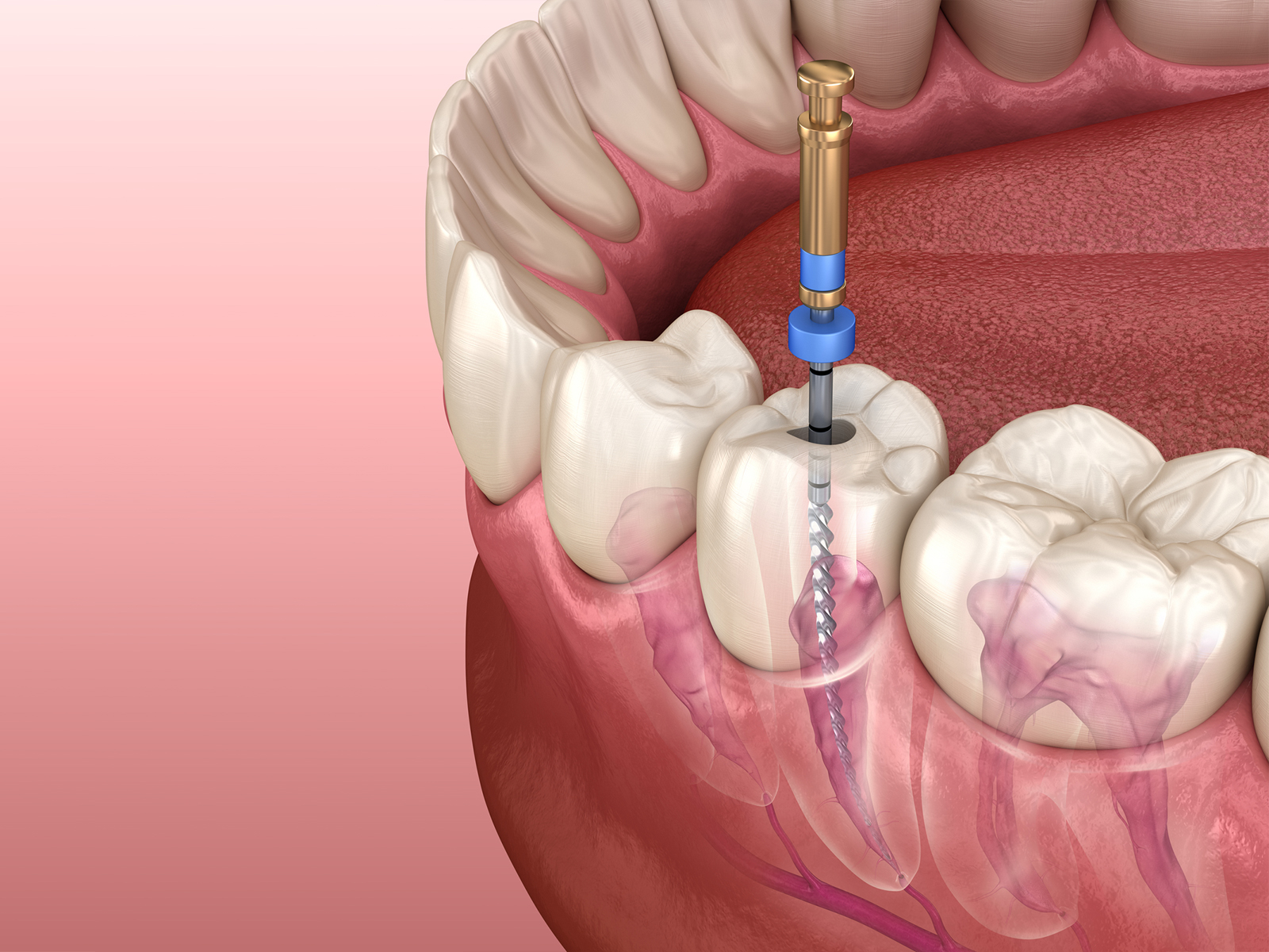 Can a Root Canal Infection Heal Itself?