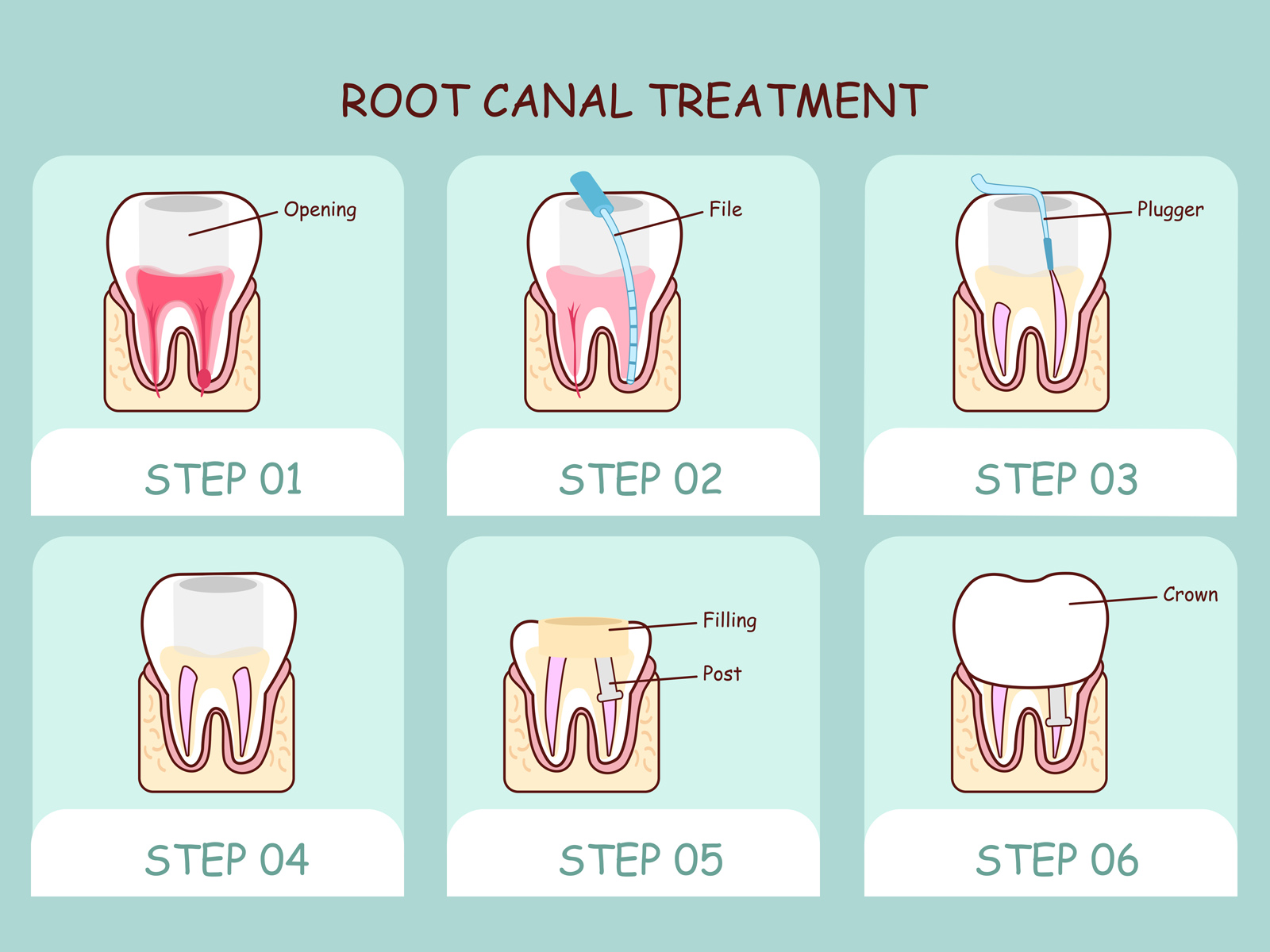 How does a tooth feel after root canal?