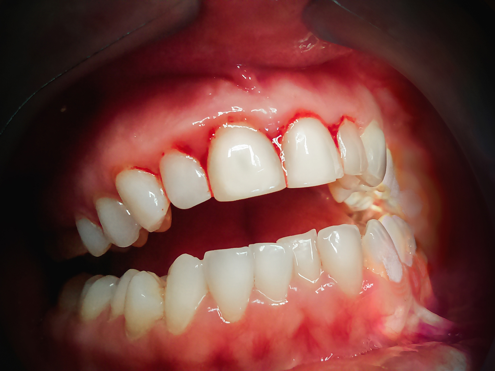 What caused Bleeding Gums?