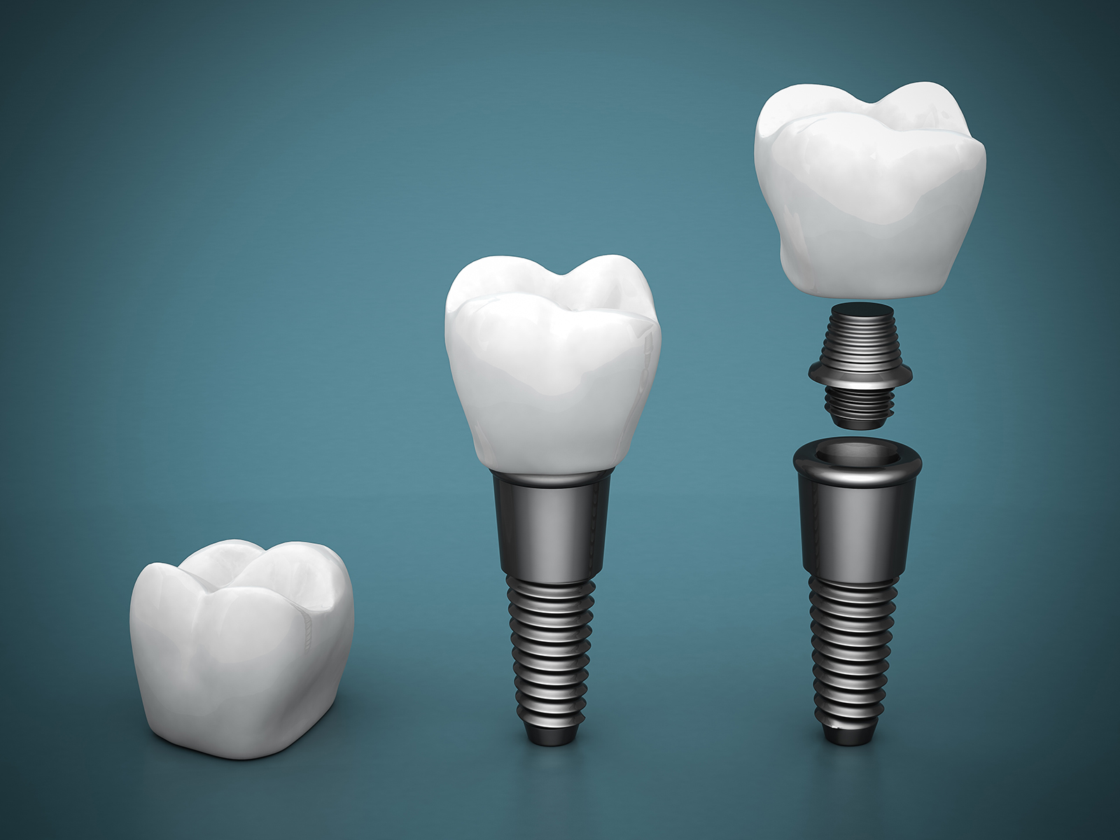 What is the difference between an implant and an abutment?