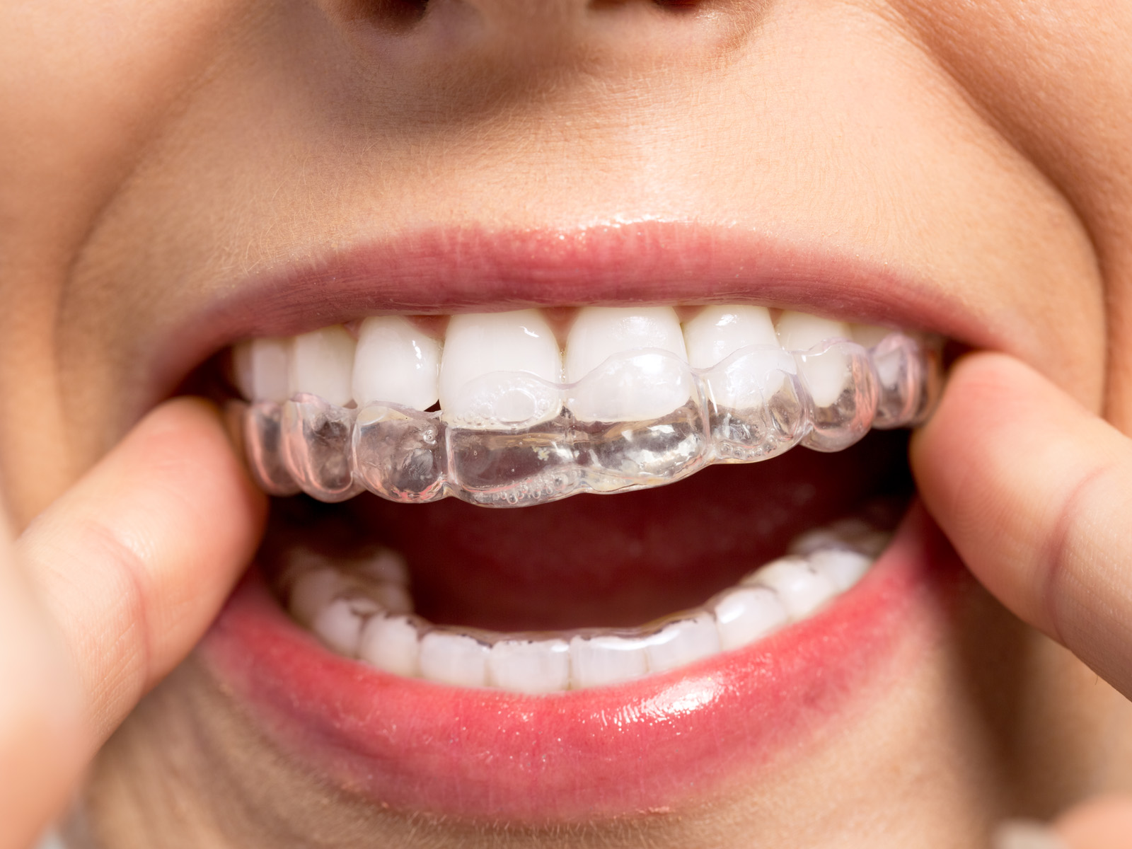 Can I take my Invisalign out for a night out?