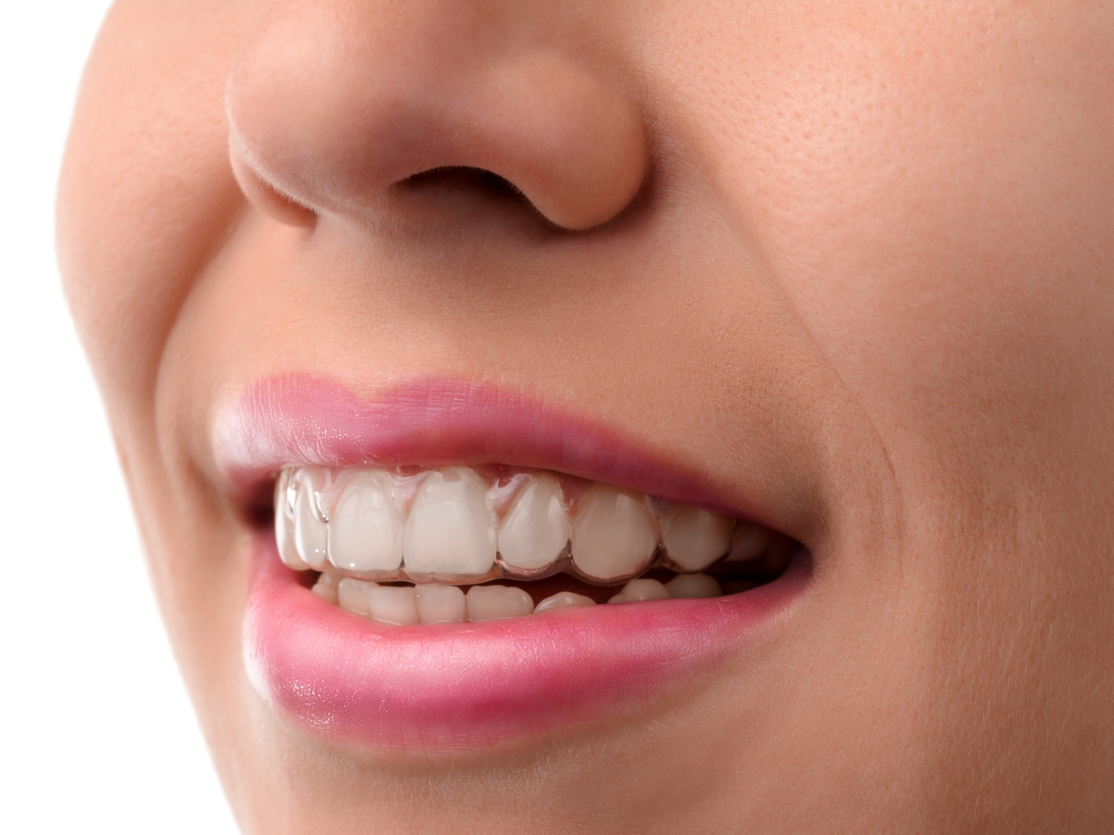 Does Invisalign make your teeth straight?
