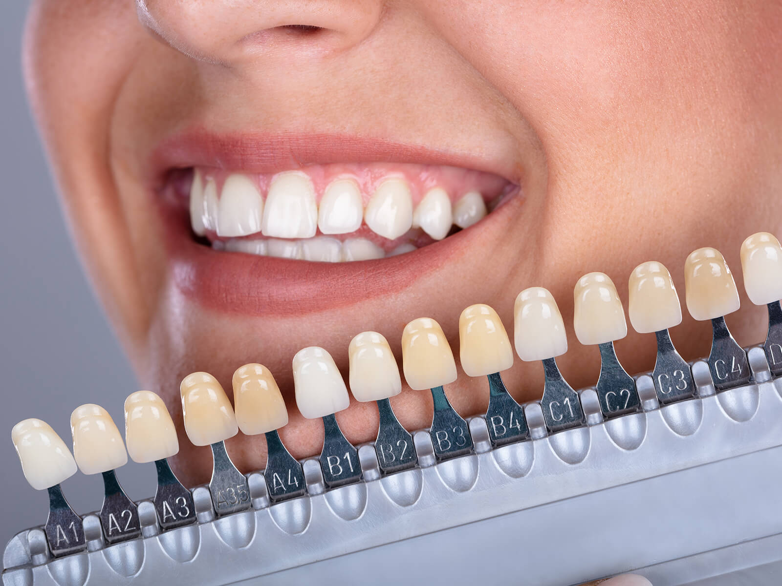 What You Need To Know Before Getting A Teeth Whitening Treatment