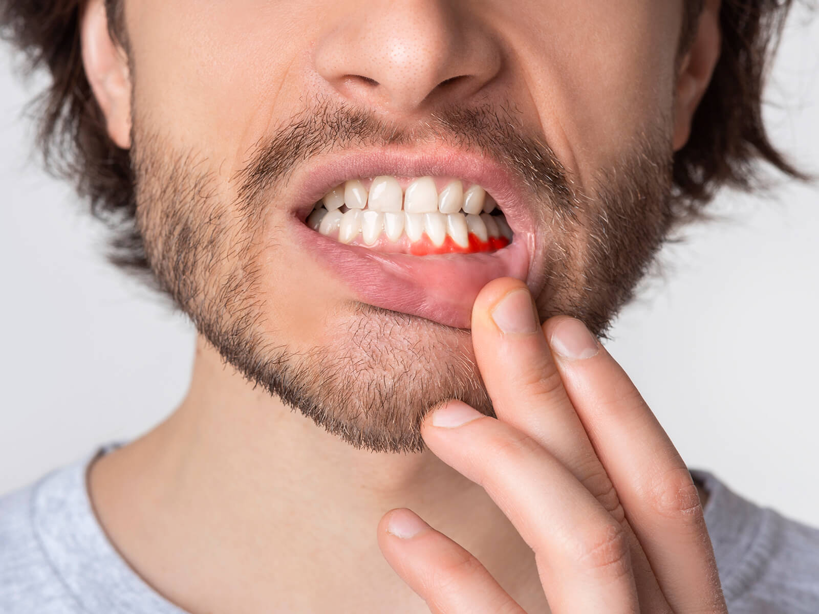 What Are The 5 Stages of Gum Disease?